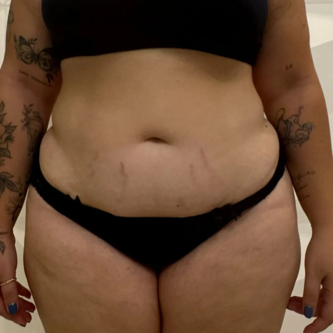 Antes - Barriga & Abdômen