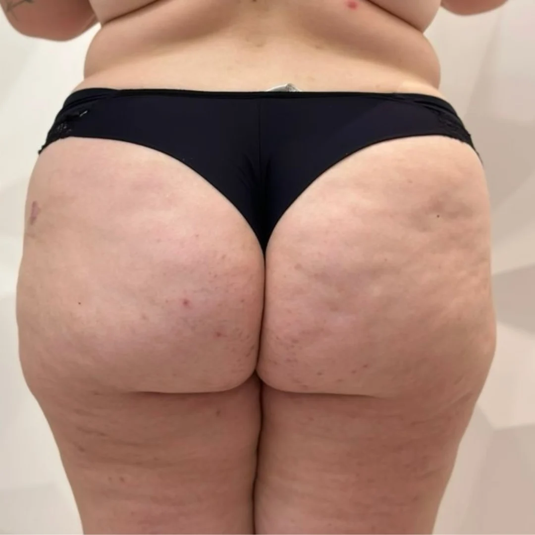 Celulite no Bumbum