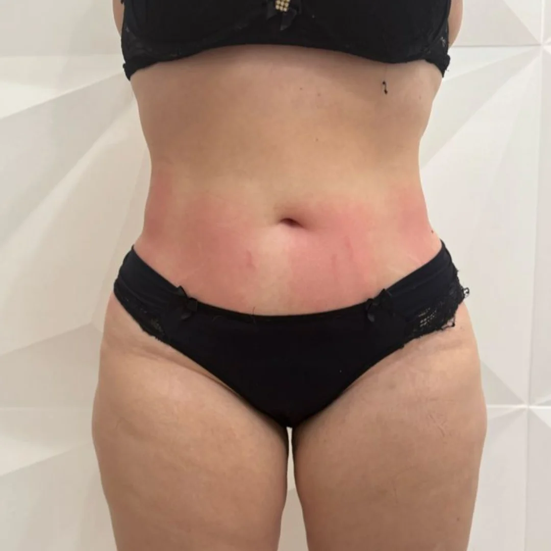 Depois - Barriga & Abdômen