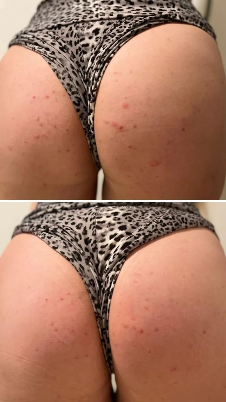 Bolinhas de Foliculite